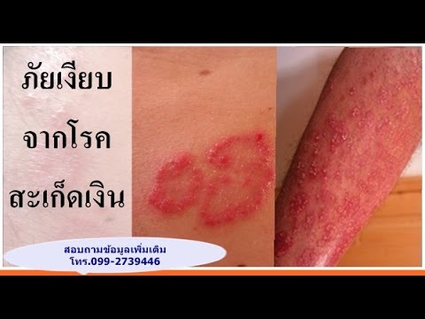 Laktofiltrum ไม่เป็นโรคสะเก็ดเงิน โรคสะเก็ดเงินในอิสราเอล