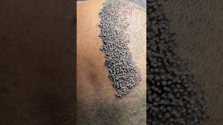 Download lagu Youth hair transplant: Focusing on Widow’s Peak reduction #vincihairclinic #shorts mp3 Download lagu Youth hair transplant: Focusing on Widow’s Peak reduction #vincihairclinic #shorts mp3