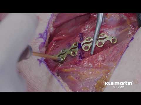 Paraspinal Rib Fracture Treatment Technique using the L1 Rib System