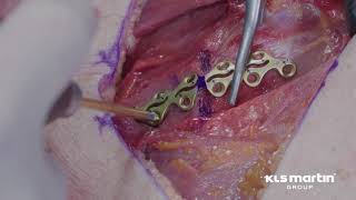 Paraspinal Rib Fracture Treatment Technique using the L1 Rib System