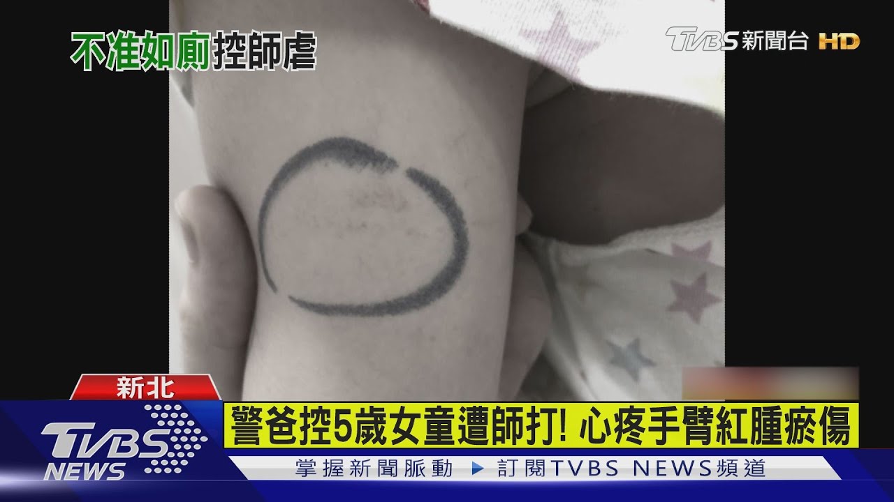 警爸控5歲女童遭師打! 心疼手臂紅腫瘀傷