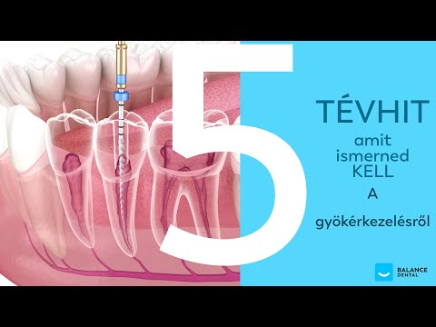 Gyökérkezelés - 5 Tévhit aminek nem szabad bedőlnöd!