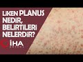 Liken Planus Nedir Belirtileri Nelerdir