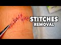 REMOVING 13 STITCHES From A Huge Leg Wound Dr Paul