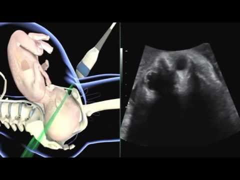 ISUOG: how to perform ultrasound in labor: assessment of fetal occiput position