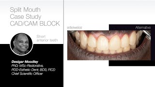 Split Mouth Case Study - CAD/CAM BLOCK