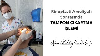 Nasal Packing Removal After Rhinoplasty
