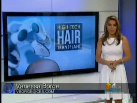 High-Tech Hair Transplant - CBS4 South Florida - Robotic Procedure for Hair Transplantation
