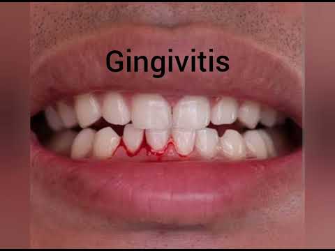 Hi Salz Toothpaste ( cure for gingvitis , swollen gums , bad breath , bleeding gums )