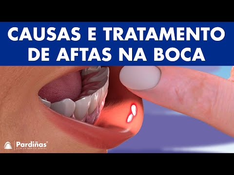 AFTA NA BOCA - Causas e tratamento de aftas ©
