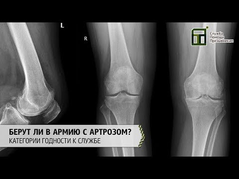 Берут ли в армию с артрозом | Категории годности к службе