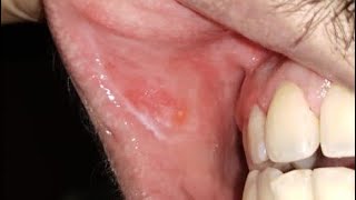 How to clear white patch in the mouth.