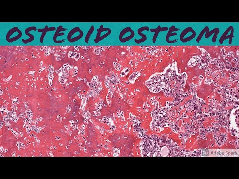 Osteoid Osteoma: Bone Pathology Basics