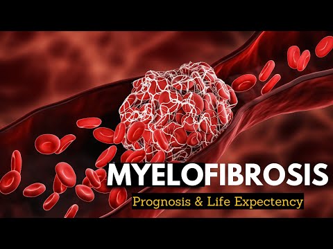 Myelofibrosis Explained: What You Need to Know