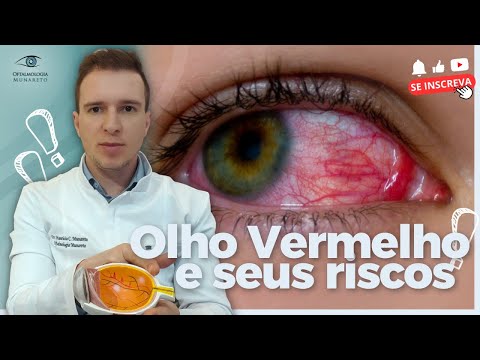 Olho Vermelho? Como ocorre o derrame ocular
