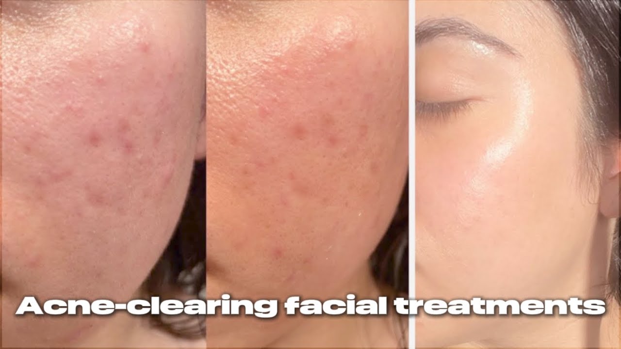 Experimental(💉)Clinic-Level Clear Skin Treatment | Glass Skin,Tight Pores,Smooth Texture ultra power