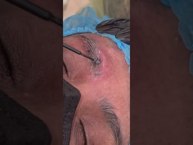 تدريب ازالة التاتو القديم