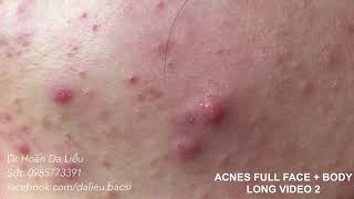 Dermatologist,squeeze pimples,whitehead blackhead, pustule,anti acnes|Full face acnes long video 2