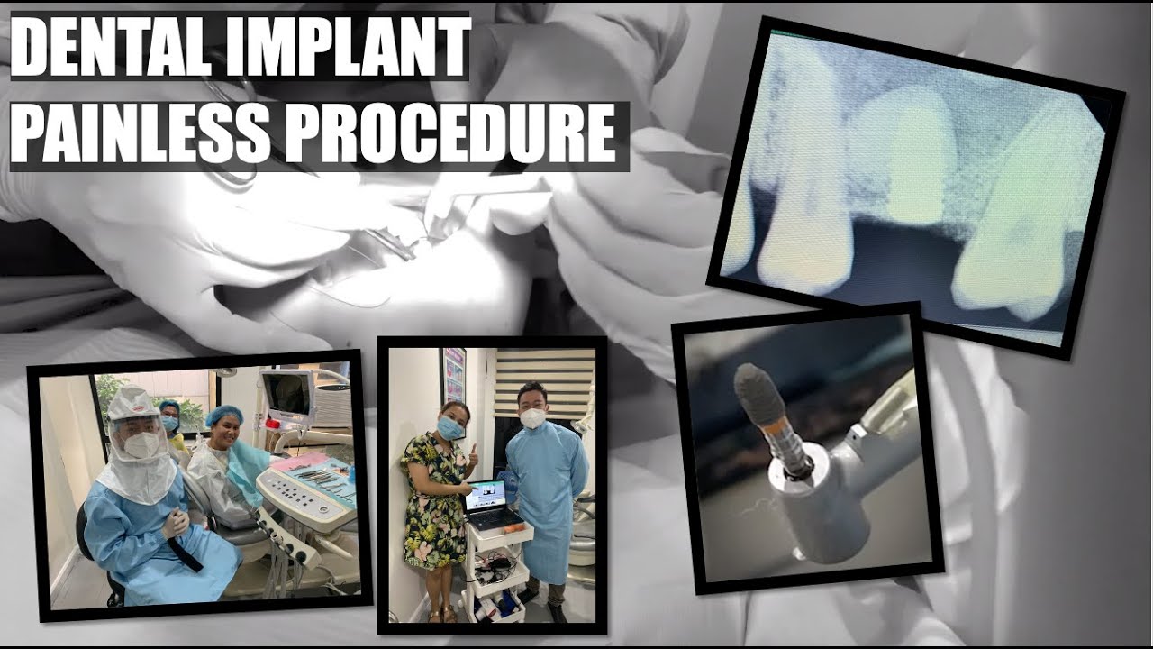 Getting Dental Implants is NOT Painful | Apostol Dental Philippines