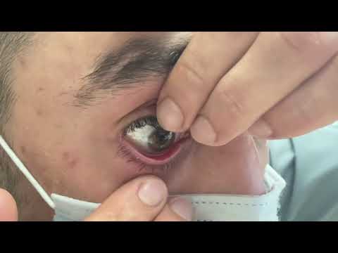 How to remove scleral lenses with eyelids only