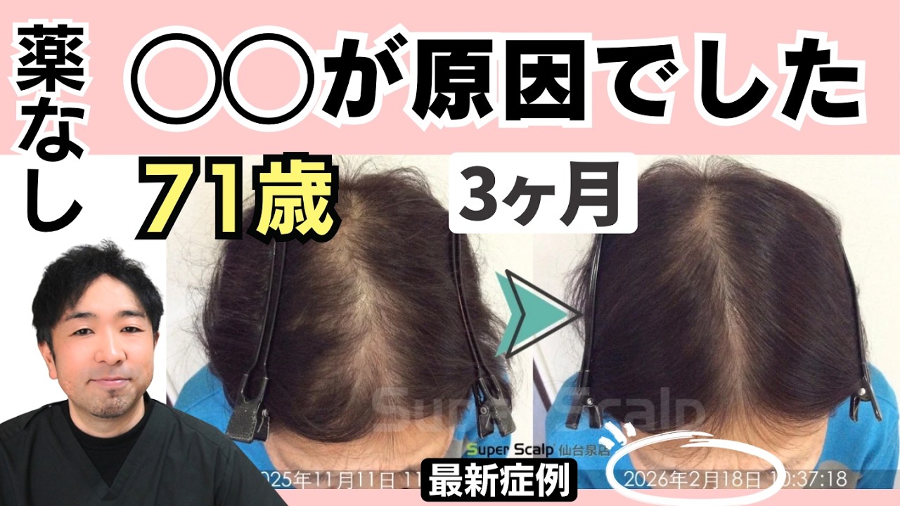 【急激な脱毛→3ヶ月で発毛】71歳女性「休止期脱毛症」の原因と対策