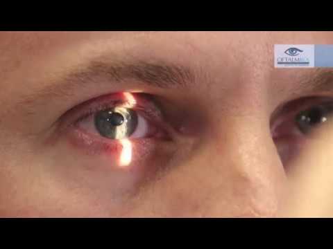 Stożek rogówki - objawy i przebieg choroby