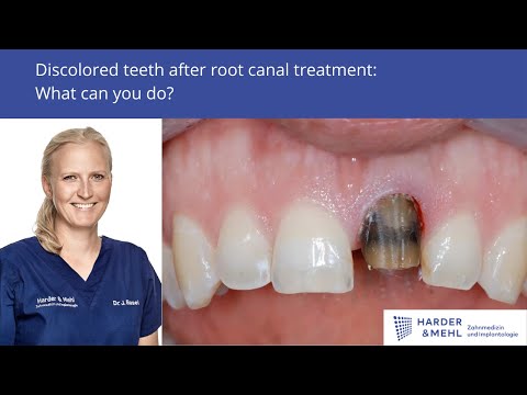 Discolored teeth after root canal treatment - what can you do?