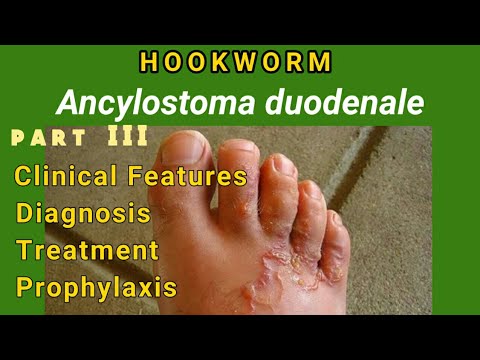a szem ankilostomiasis mi a galandféreg féreg