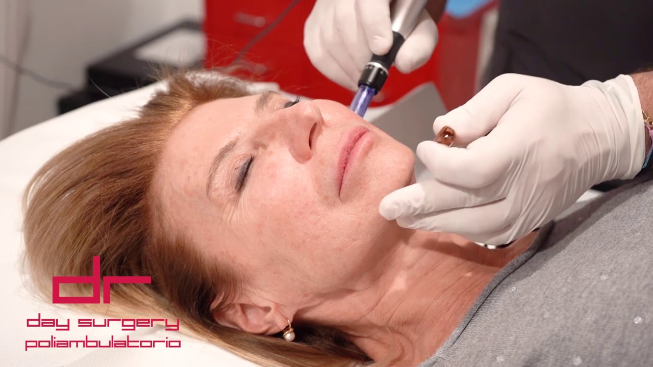 NEEDLING DERMAPEN - Corregge le imperfezioni della pelle