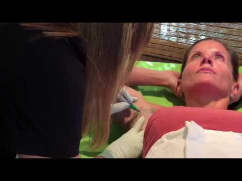 Watch a Live miraDry Procedure