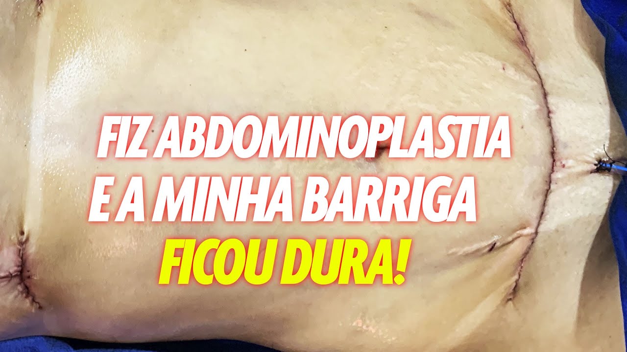 PORQUE A PELE FICA DURA APÓS ABDOMINOPLASTIA? CIRURGIA PLÁSTICA