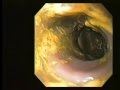 Colonoscopy & Colon Cleanse - Body Detox: Natural Bowel,Blood Cleansing,Kidney,Liver Detoxification