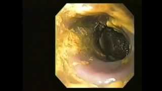 Colonoscopy & Colon Cleanse - Body Detox: Natural Bowel,Blood Cleansing,Kidney,Liver Detoxification