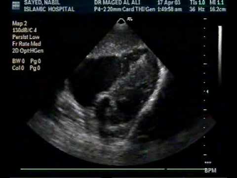 Ebstein's Anomaly In An Adult (1/2)