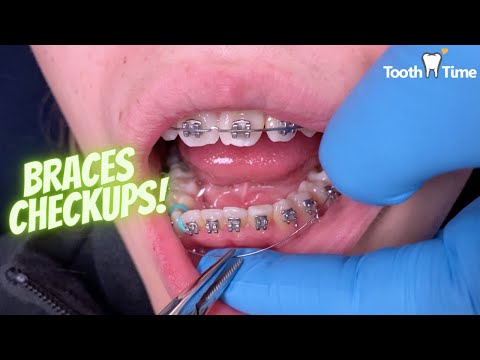 Braces Checkup - 9 months progress- Changing lower wire - Tooth Time Family Dentistry New Braunfels