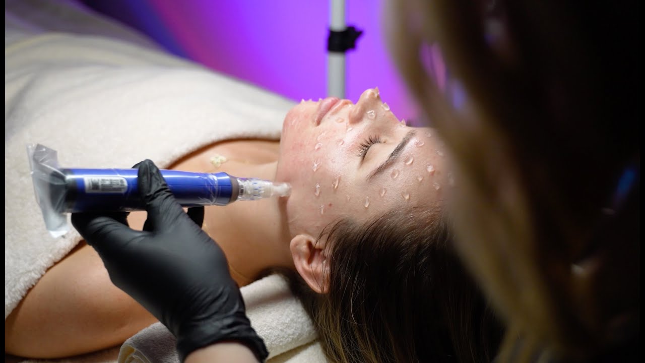 SkinPen Microneedling Treatment at Elevate Medical Spa