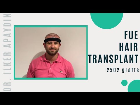 FUE hair transplant, 2502 Grafts with Dr. Ilker Apaydin in Turkey