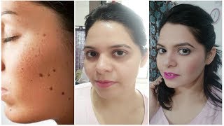 तिल को हटाने के घरेलू उपाय||How To Remove til/Warts Naturally||ShimmeringShraddha