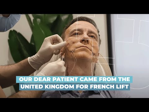 Our dear patient came from the United Kingdom for French Lift