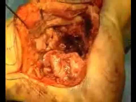 Amrita Khokhar : surgery video