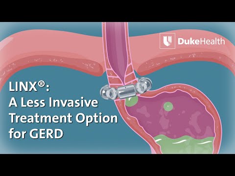 Using LINX® to Treat GERD  | Duke Health