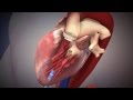 Edwards SAPIEN Transcatheter Heart Valve With The Ascendra Transapical Delivery System