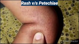 Rash v/s Petechiae I Pediatrics