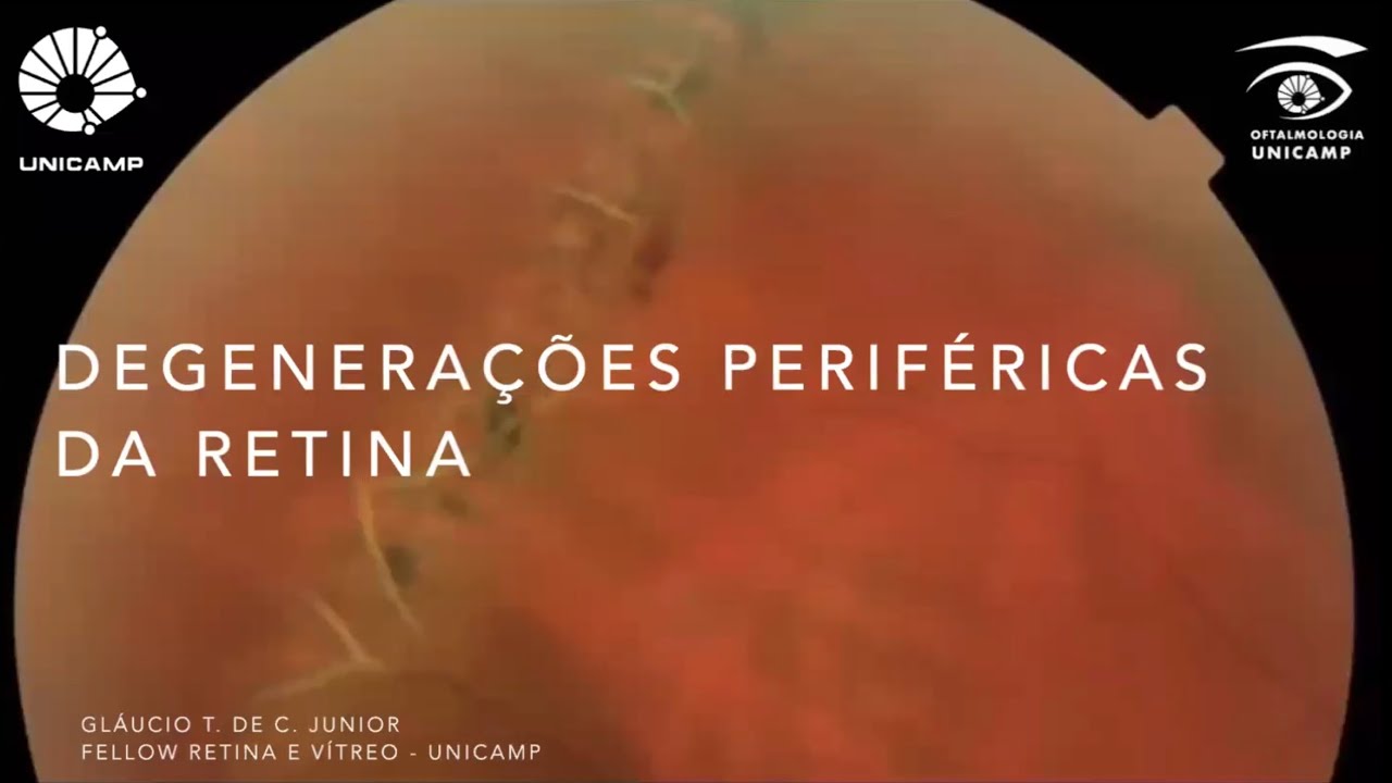 Retina e Vítreo (17/10/2024) - Degenerações Periféricas da Retina