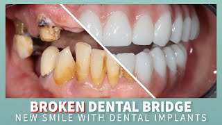 Broken Bridge: Smile Restored with a new smile on Innovative Dental Implants