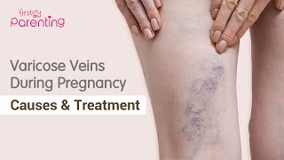 How to Deal With Varicose Veins During Pregnancy?