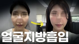 얼굴지방흡입으로 윤곽수술 효과 내는 방법 ㅣ성형비포에프터ㅣ뷰티라인성형외과
