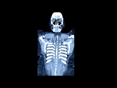 A Woman Ate 23 Bananas After Fasting 7 Days. This Is What Happened To Her Organs.