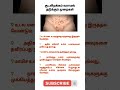 குடல் இறக்கம் வராமல் தடுக்கும் முறைக