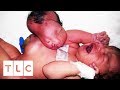 Baby Born With Two Heads Gets Vital Surgery Body Bizarre